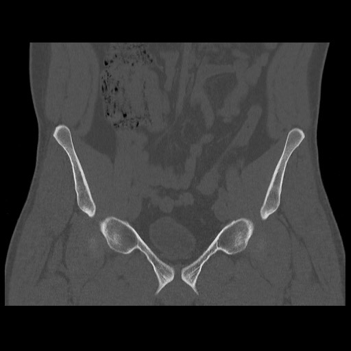 Chondrosarcoma of iliac wing (Radiopaedia 63861-72599 Coronal bone window 42).jpg