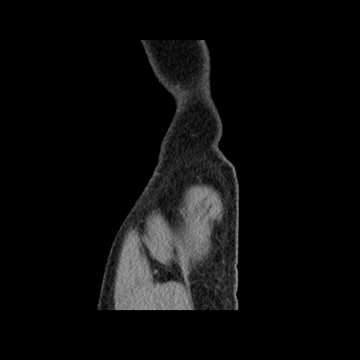 Chondrosarcoma of iliac wing (Radiopaedia 63861-72599 F 172).jpg