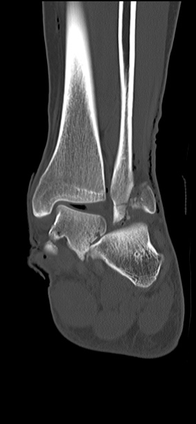 Chopart fracture (Radiopaedia 35347-36851 Coronal bone window 29).jpg