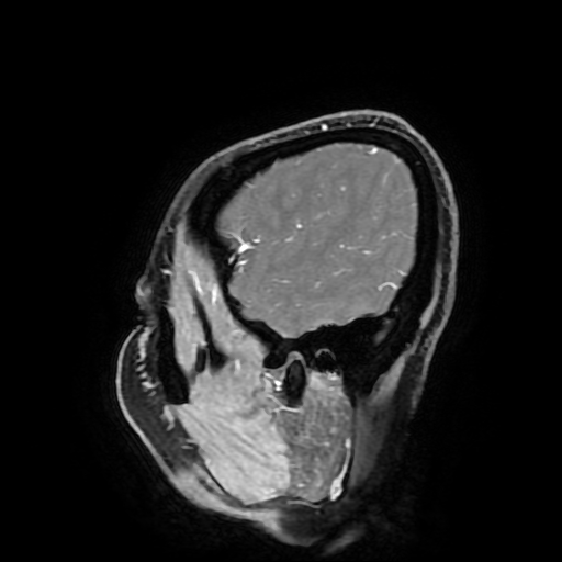 Chordoid glioma of third ventricle (Radiopaedia 91612-109340 F 38).jpg