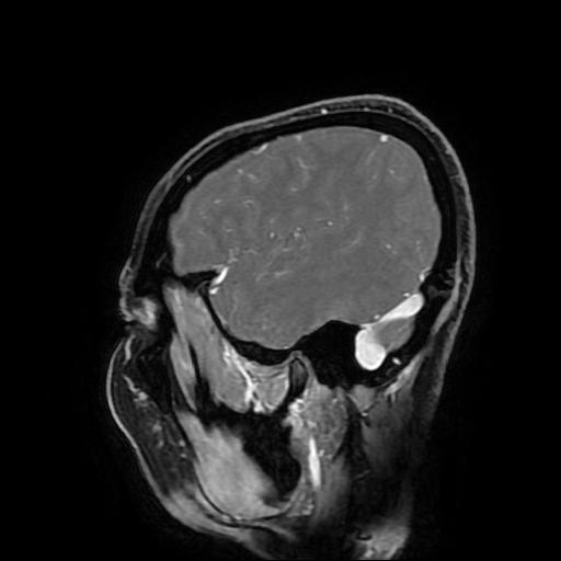 Chordoid glioma of third ventricle (Radiopaedia 91612-109340 F 49).jpg
