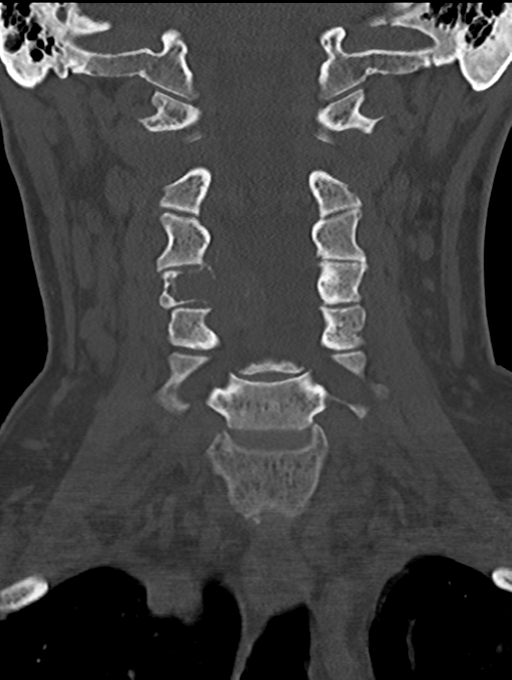 Chordoma (C4 vertebra) (Radiopaedia 47561-52188 Coronal bone window 23).png