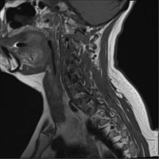 File:Chordoma (C4 vertebra) (Radiopaedia 47561-52189 Sagittal T1 2).png