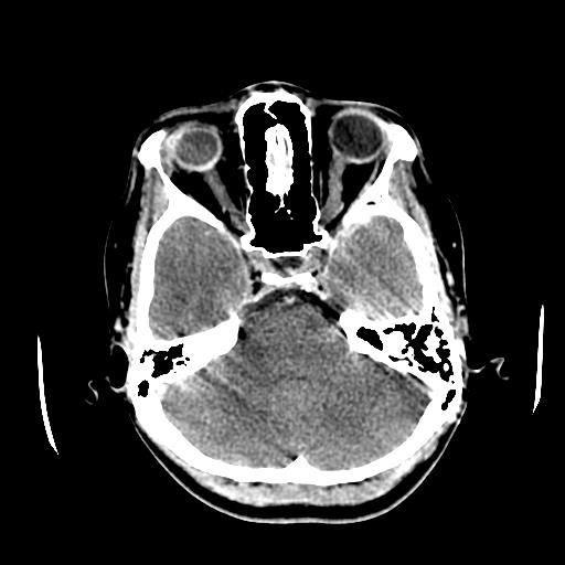 File:Choriocarcinoma of ovary with cerebral and pulmonary metastases (Radiopaedia 25983-26118 C+ arterial phase 39).jpg