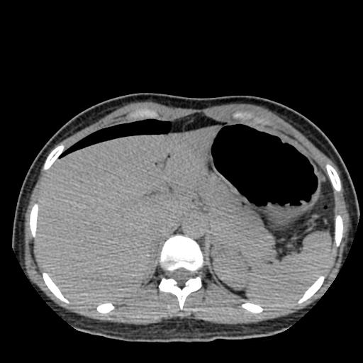 File:Choriocarcinoma of ovary with cerebral and pulmonary metastases (Radiopaedia 25983-26119 Axial non-contrast 69).jpg