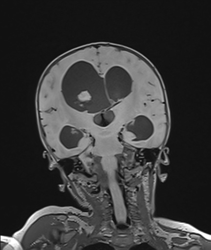 Choroid plexus papilloma (Radiopaedia 84612-100019 Coronal FLAIR 73).jpg