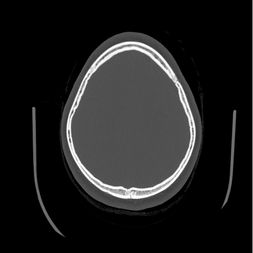 Choroid plexus papilloma extending into the cerebellopontine angle cistern (Radiopaedia 85941-101833 Axial bone window 73).png