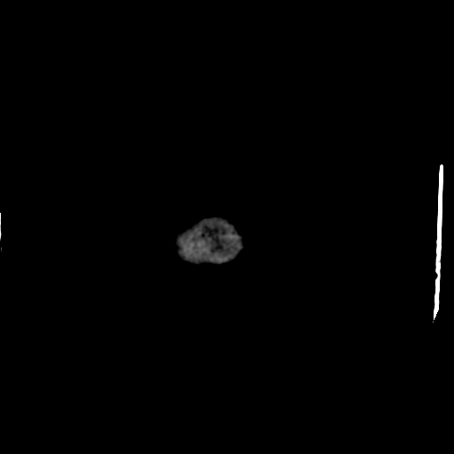Choroid plexus xanthogranulomas (Radiopaedia 51621-57408 Axial non-contrast 124).jpg