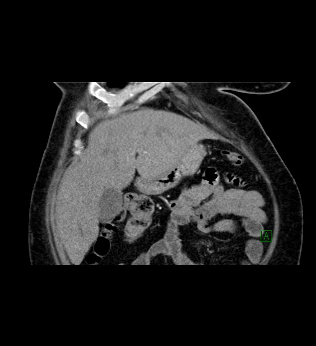 Chromophobe renal cell carcinoma (Radiopaedia 84239-99519 C 23).jpg