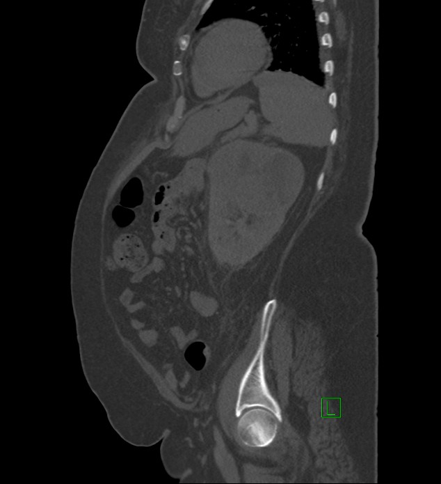 Chromophobe renal cell carcinoma (Radiopaedia 84239-99519 Sagittal bone window 26).jpg