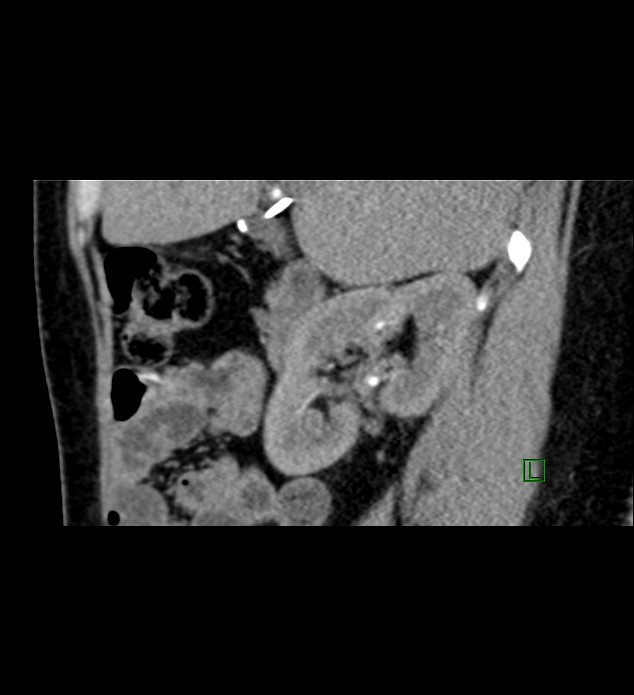 Chromophobe renal cell carcinoma (Radiopaedia 84290-99582 D 66).jpg
