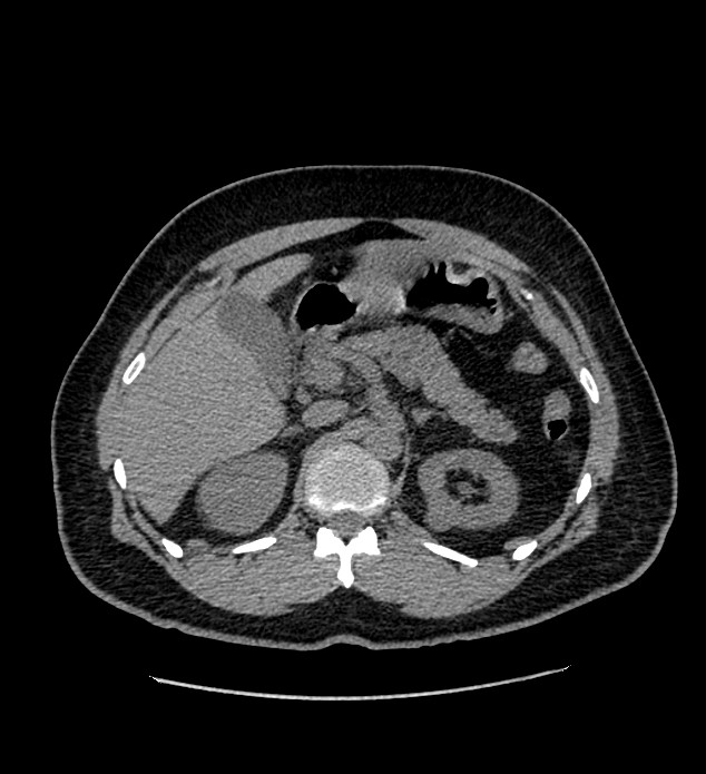 Chromophobe renal cell carcinoma (Radiopaedia 84337-99693 Axial non-contrast 40).jpg