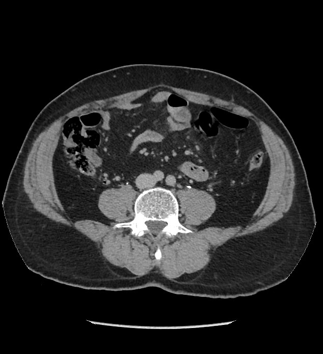 Chromophobe renal cell carcinoma (Radiopaedia 86879-103083 D 89).jpg