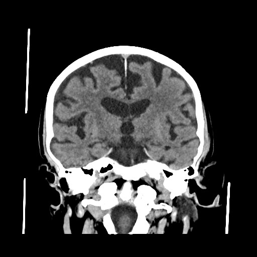 Chronic bilateral subdural hygroma (Radiopaedia 85801-101622 Coronal non-contrast 44).jpg
