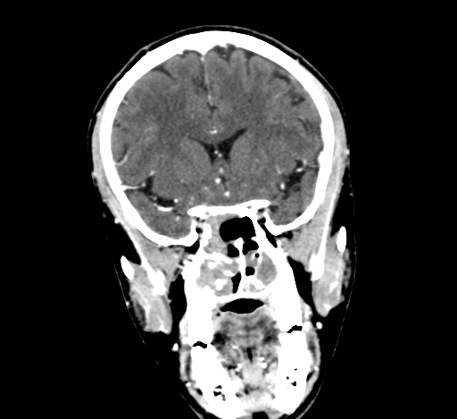 Chronic invasive fungal sinusitis with intraorbital and intracranial extension (Radiopaedia 56387-63046 C 149).jpg