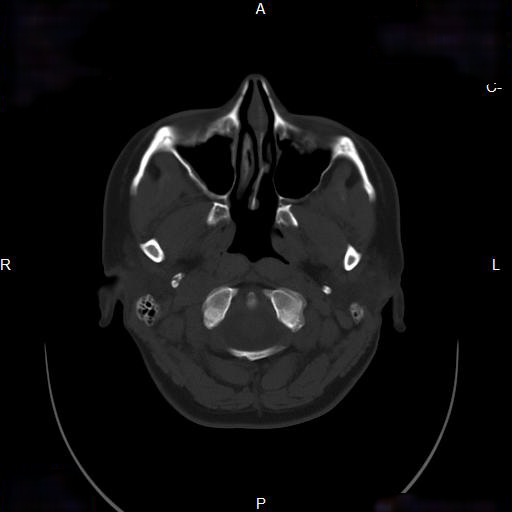 File:Chronic maxillary sinusitis with a foreign body (dental filling material) (Radiopaedia 7811-8639 Axial bone window 7).jpg