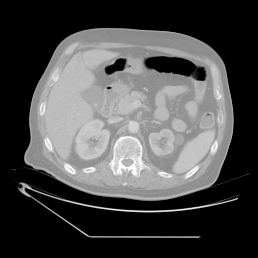 File:Chronic mesenteric ischemia - arterial (Radiopaedia 88205-104810 Axial lung window 1).jpg