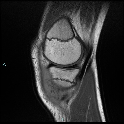 File:Chronic osteomyelitis (with Brodie abscess) (Radiopaedia 76405-88112 Sagittal PD 6).jpg