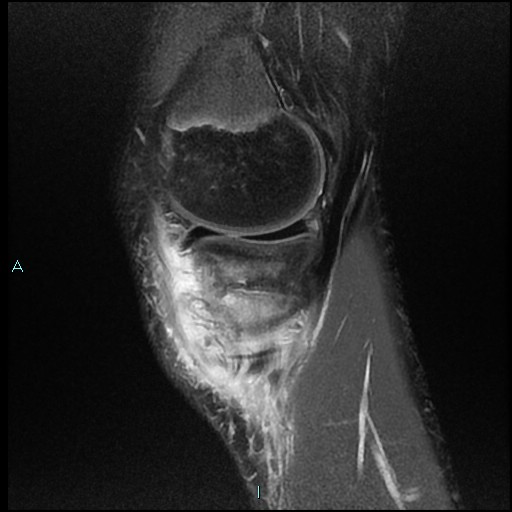 File:Chronic osteomyelitis (with Brodie abscess) (Radiopaedia 76405-88112 Sagittal PD fat sat 5).jpg