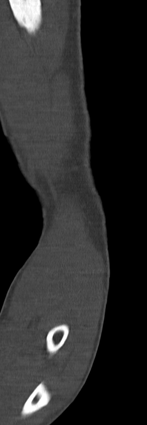 Chronic osteomyelitis of the distal humerus (Radiopaedia 78351-90971 Sagittal bone window 32).jpg