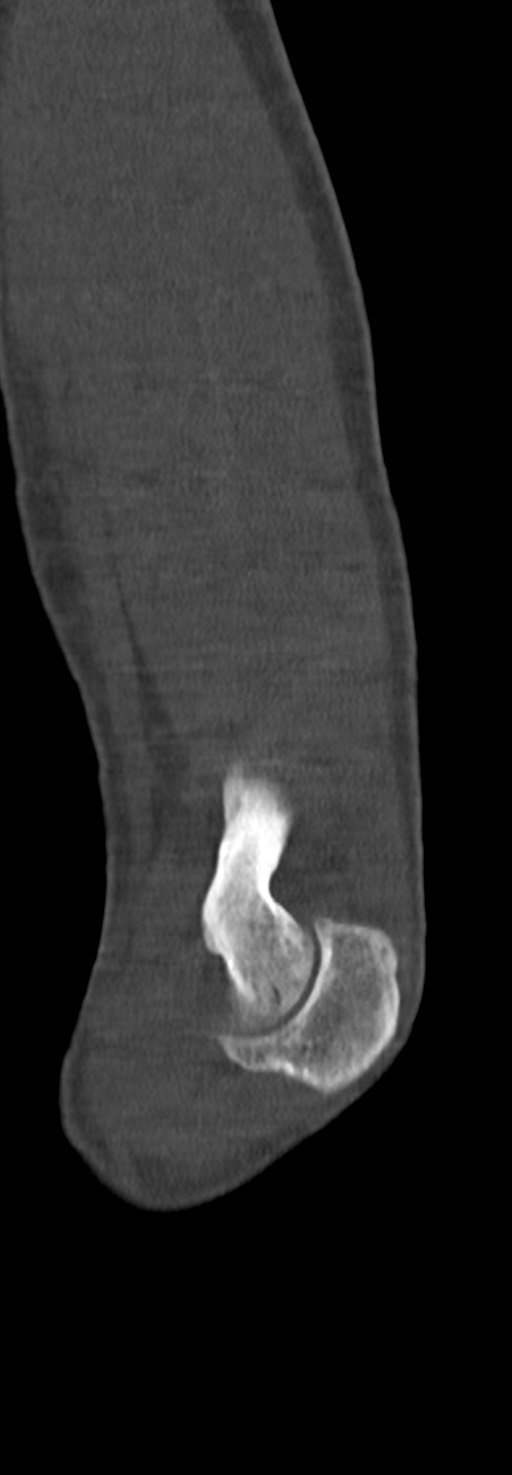 Chronic osteomyelitis of the distal humerus (Radiopaedia 78351-90971 Sagittal bone window 59).jpg