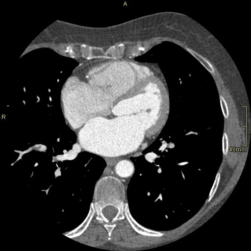 Chronic pulmonary embolism (Radiopaedia 73073-85094 Axial C+ CTPA 93).jpg