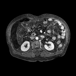 Cirrhosis and hepatocellular carcinoma in the setting of hemochromatosis (Radiopaedia 75394-86594 Axial T1 C+ fat sat 190).jpg