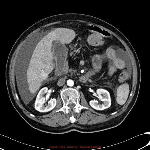 File:Cirrhosis and hepatocellular carcinoma in the setting of hemochromatosis (Radiopaedia 75394-86595 A 39).jpg