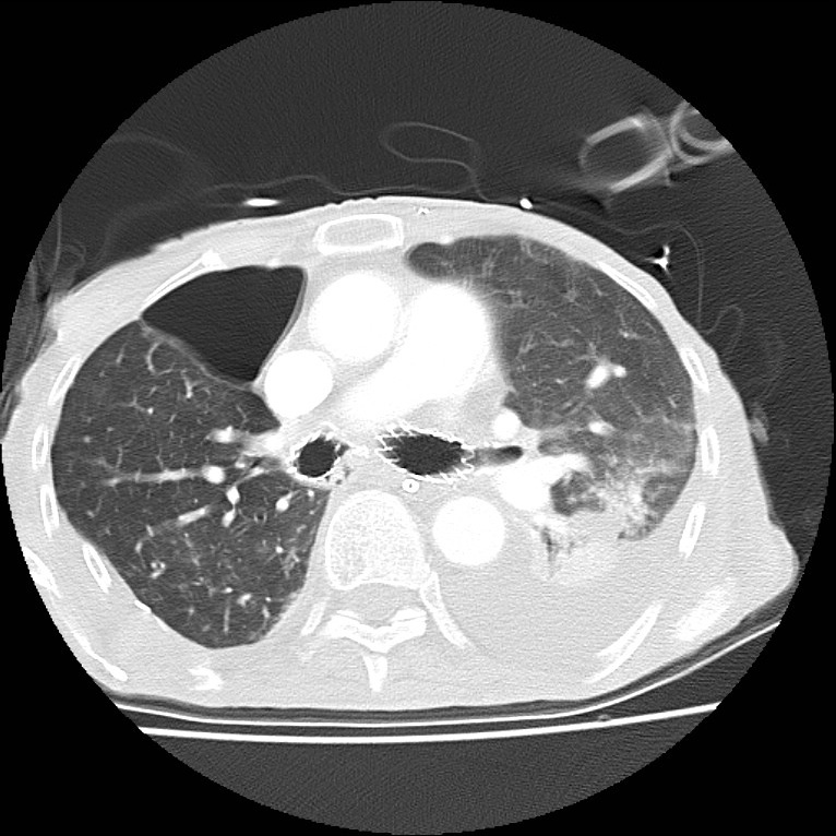 Clagett thoracotomy with bronchopleural fistula (Radiopaedia 29192-29587 Axial lung window 22).jpg