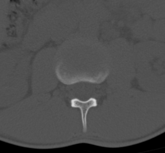 Clear cell meningoma - lumbar spine (Radiopaedia 60116-67691 Axial bone window 19).png