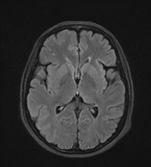 File:Clival meningioma (Radiopaedia 53278-59248 Axial FLAIR 13).jpg