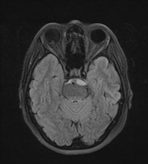 File:Clival meningioma (Radiopaedia 53278-59248 Axial FLAIR 8).jpg