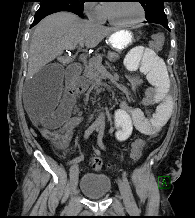Closed-loop small bowel obstruction-internal hernia (Radiopaedia 78439-91096 Coronal non-contrast 46).jpg