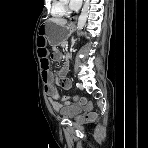 Closed loop obstruction due to adhesive band, resulting in small bowel ischemia and resection (Radiopaedia 83835-99023 F 109).jpg