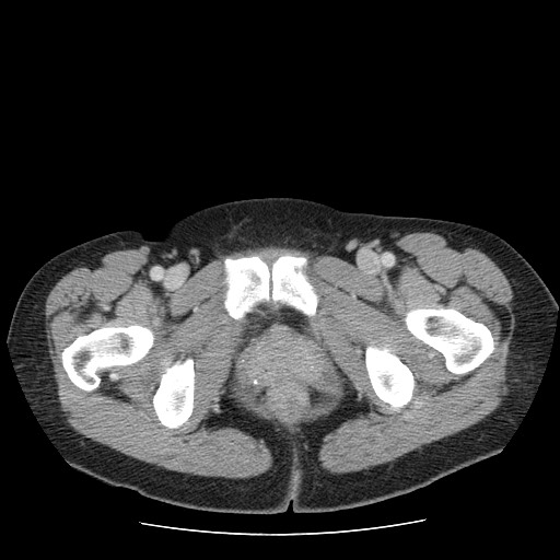File:Closed loop small bowel obstruction (Radiopaedia 65403-74451 A 81).jpg