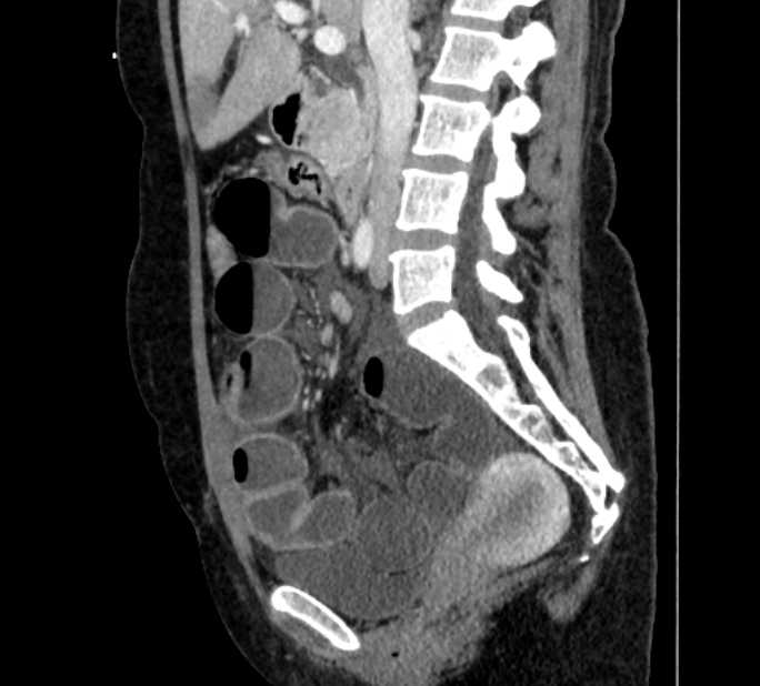 Closed loop small bowel obstruction (Radiopaedia 71211-81508 C 65).jpg