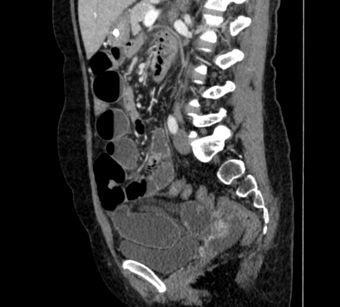 Closed loop small bowel obstruction (Radiopaedia 71211-81508 C 89).jpg