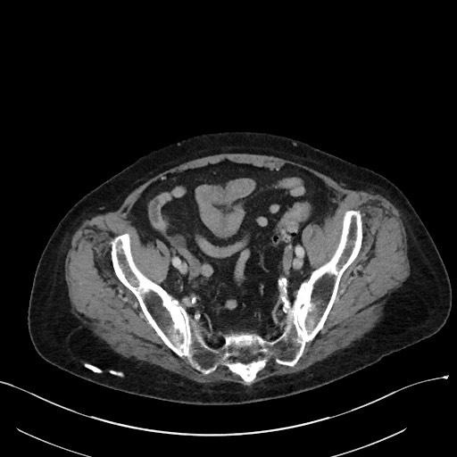 File:Closed loop small bowel obstruction - adhesions (Radiopaedia 59269-66611 A 105).jpg