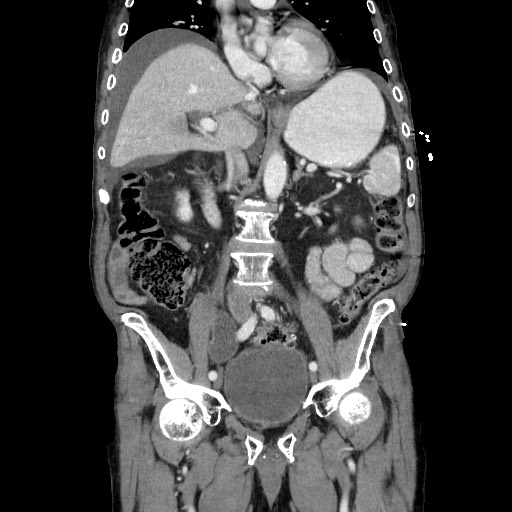 Closed loop small bowel obstruction - adhesive disease and hemorrhagic ischemia (Radiopaedia 86831-102990 B 66).jpg