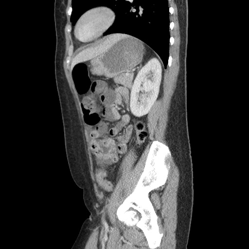 Closed loop small bowel obstruction due to trans-omental herniation (Radiopaedia 35593-37109 C 47).jpg