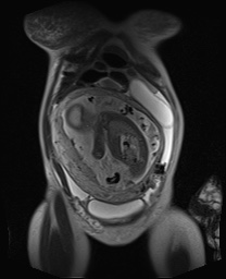 File:Closed loop small bowel obstruction in pregnancy (MRI) (Radiopaedia 87637-104031 Coronal T2 17).jpg