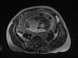Closed loop small bowel obstruction in pregnancy (MRI) (Radiopaedia 87637-104031 D 17).jpg