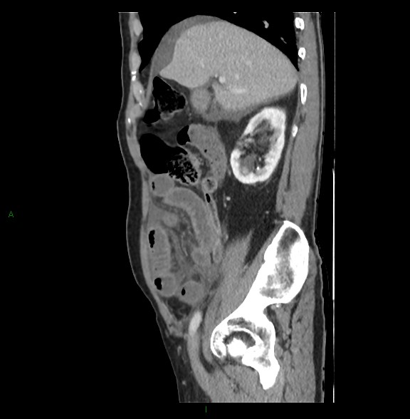 Closed loop small bowel obstruction with ischemia (Radiopaedia 84180-99456 C 29).jpg