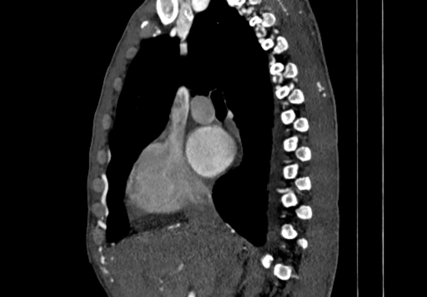 Coarctation of aorta with aortic valve stenosis (Radiopaedia 70463-80574 B 16).jpg