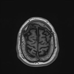 Cochlear incomplete partition type III associated with hypothalamic hamartoma (Radiopaedia 88756-105498 Axial T1 172).jpg