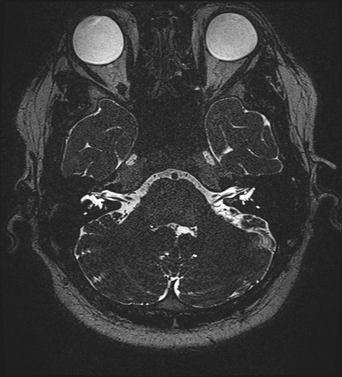 Cochlear incomplete partition type III associated with hypothalamic hamartoma (Radiopaedia 88756-105498 Axial T2 72).jpg