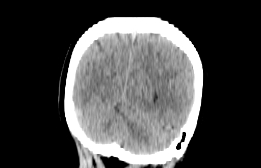 Colloid cyst (Radiopaedia 88663-105373 Coronal non-contrast 56).jpg