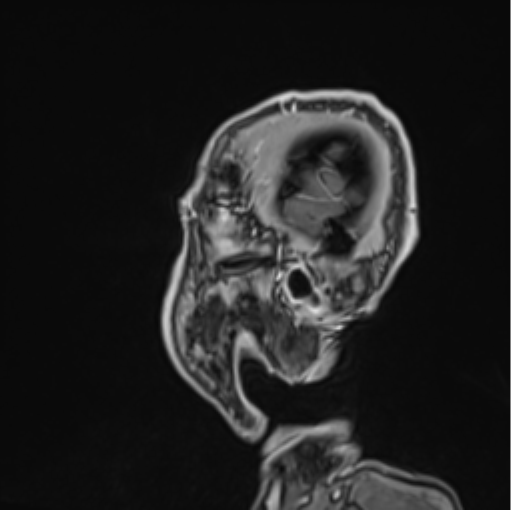 Colloid cyst of the third ventricle (Radiopaedia 86571-102662 Sagittal T1 C+ 72).png