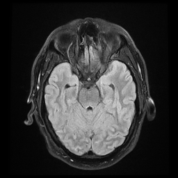 File:Colloid cyst with anterior communicating artery aneurysm (Radiopaedia 33901-35091 Axial FLAIR 8).jpg