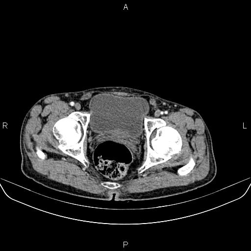 Colon adenocarcinoma - hepatic flexure (Radiopaedia 85635-101395 A 92).jpg